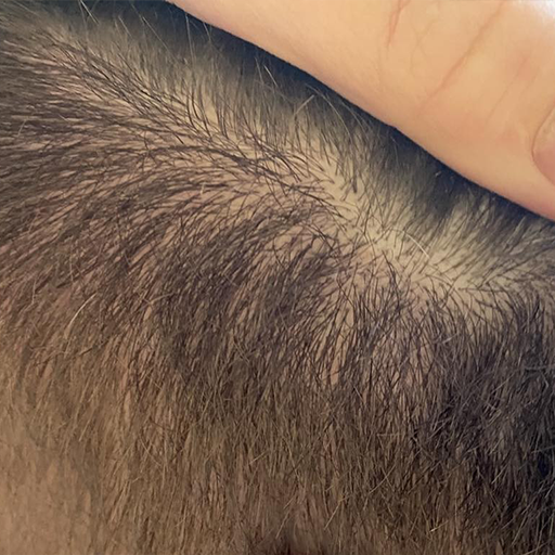 Serum protiv peruti - kraj tretmana.png__PID:8930ef8f-4bd2-4f49-abd4-134849f5f2da