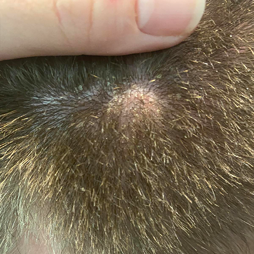 Serum protiv peruti - u toku tretmana.png__PID:9b3a634d-8930-4f8f-8bd2-6f496bd41348